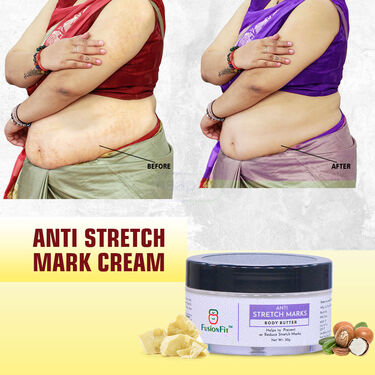 Anti Stretch Mark Cream