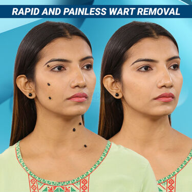 Painless Wart Removal Gel With Mark Removal Cream