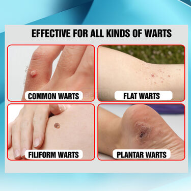 Painless Wart Removal Gel With Mark Removal Cream